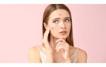 Ten acneic: ce reprezintă și cum poți combate eficient simptomele acestei probleme dermatologice