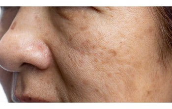 Petele pigmentare. Cum sa le tratezi eficient?