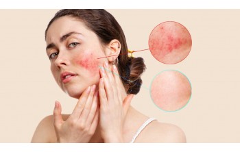 Rozacee. Tratament si Preventie